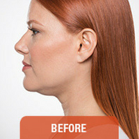 Kybella Fat Reduction at CGT Aesthetics