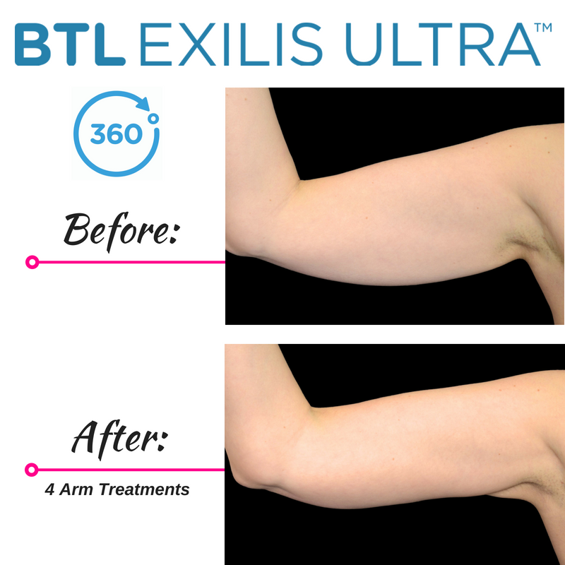 Exilis Ultra 360 | CGT Aesthetics