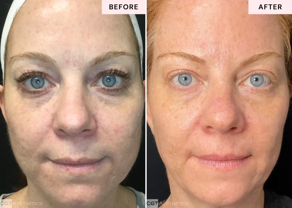 1540-resurfacing-laser-skin-texture-before-and-after-evergreen-park-westmont-il