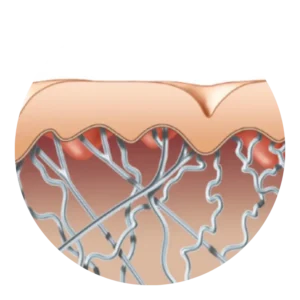 Illustration demonstrating how Exilis Ultra 360 helps tighten and firm the appearance of skin at CGT Aesthetics
