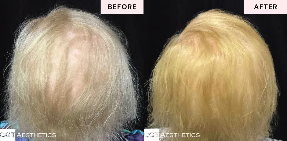 Before and after Alma TED hair restoration at CGT Aesthetics showing improved hair density and fuller-looking hair on the scalp.