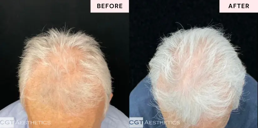 Alma TED hair thinning before and after for men at CGT Aesthetics in Evergreen Park and Westmont