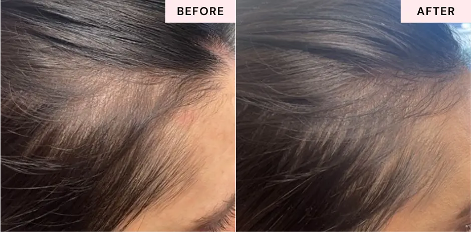 Alma Ted Hair Restoration before and after treatment from CGT Aesthetics