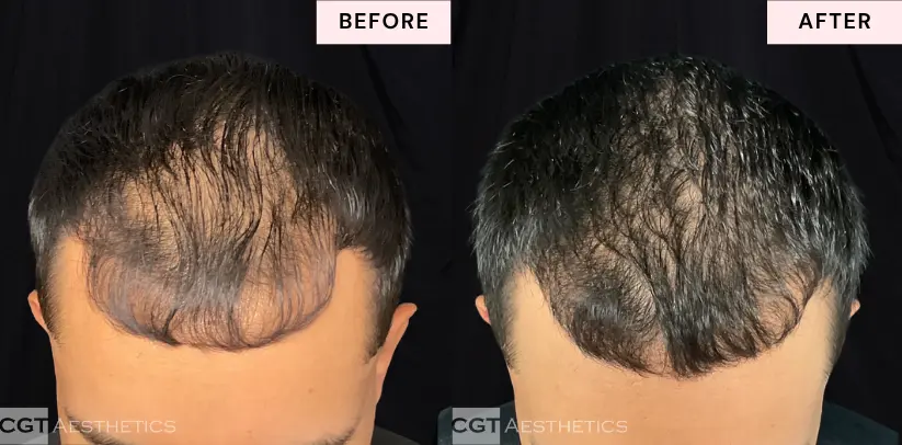 Alma TED male hair restoration before and after at CGT Aesthetics in Evergreen Park and Westmont