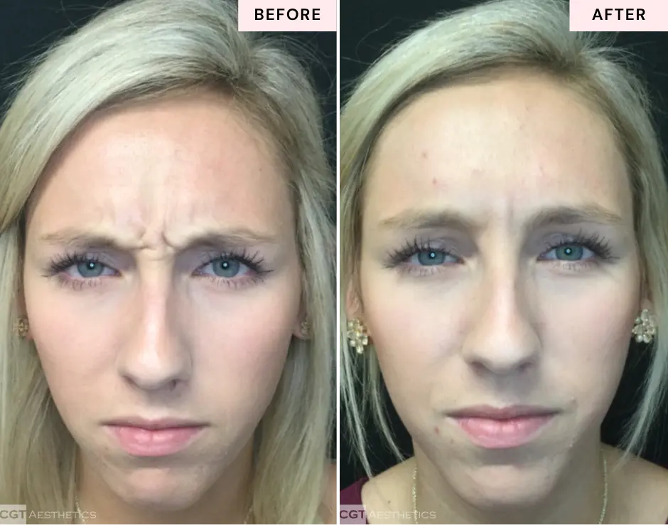 Botox 11 lines before and after at CGT Aesthetics in Evergreen Park and Westmont