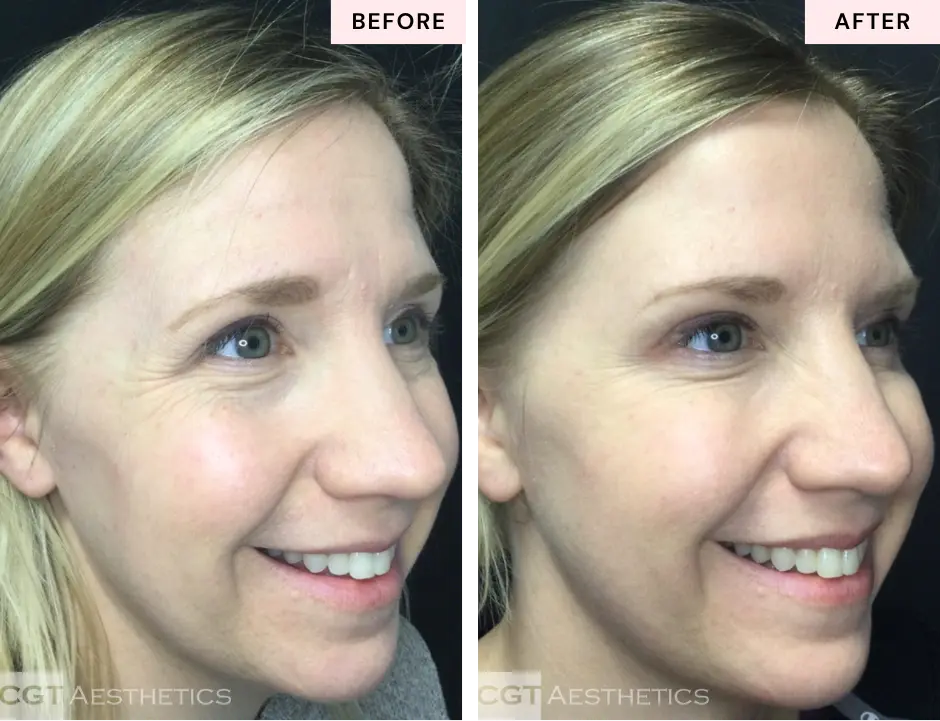 Botox crow’s feet before and after at CGT Aesthetics in Evergreen Park and Westmont