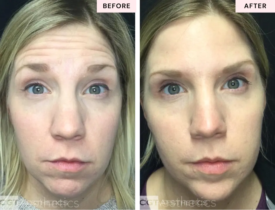 Botox forehead lines before and after at CGT Aesthetics in Evergreen Park and Westmont