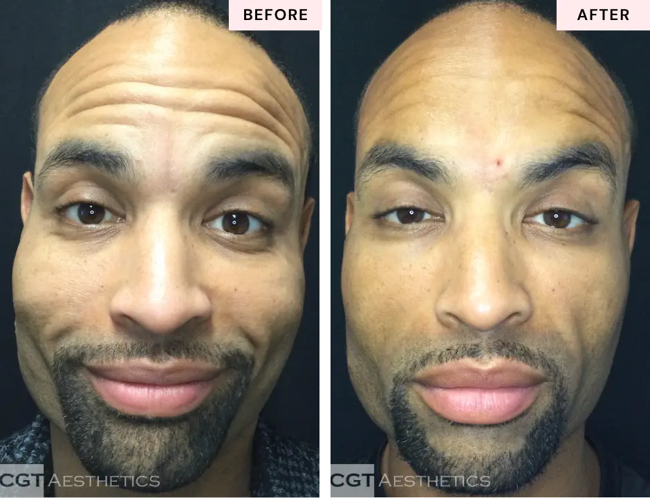 Botox forehead lines before and after for men at CGT Aesthetics in Evergreen Park and Westmont