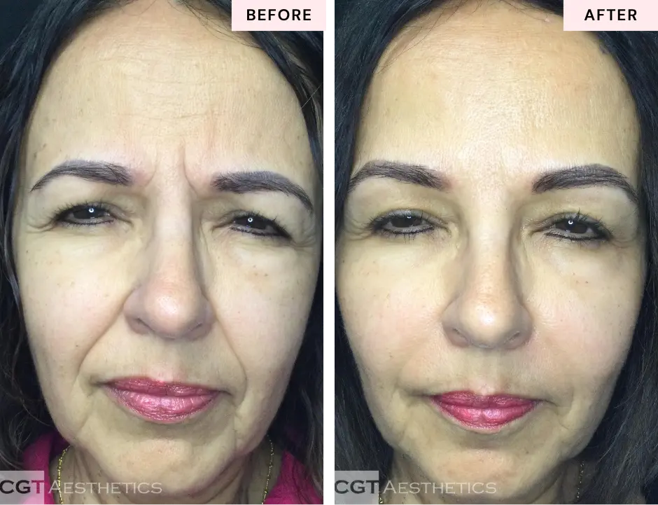 Botox 11 lines before and after at CGT Aesthetics in Evergreen Park and Westmont