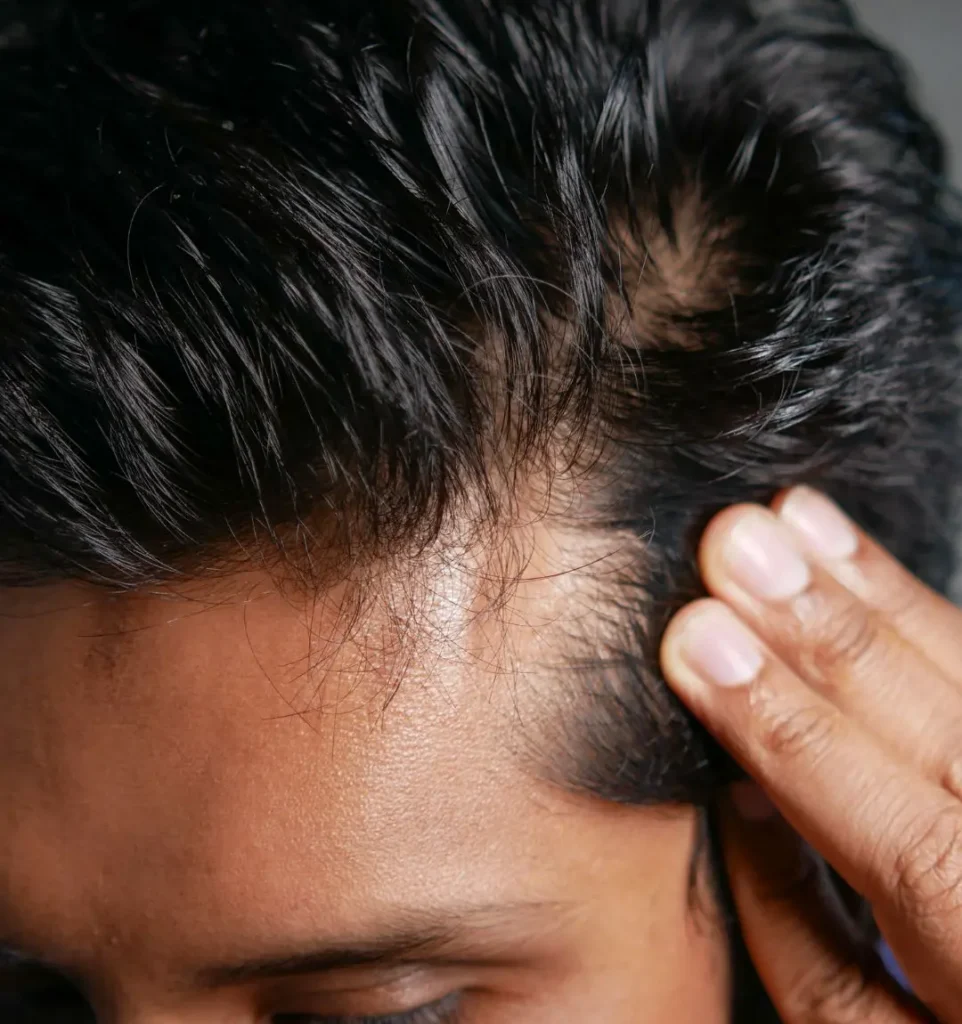 Platelet-rich plasma hair restoration treatment in Evergreen Park and Westmont IL