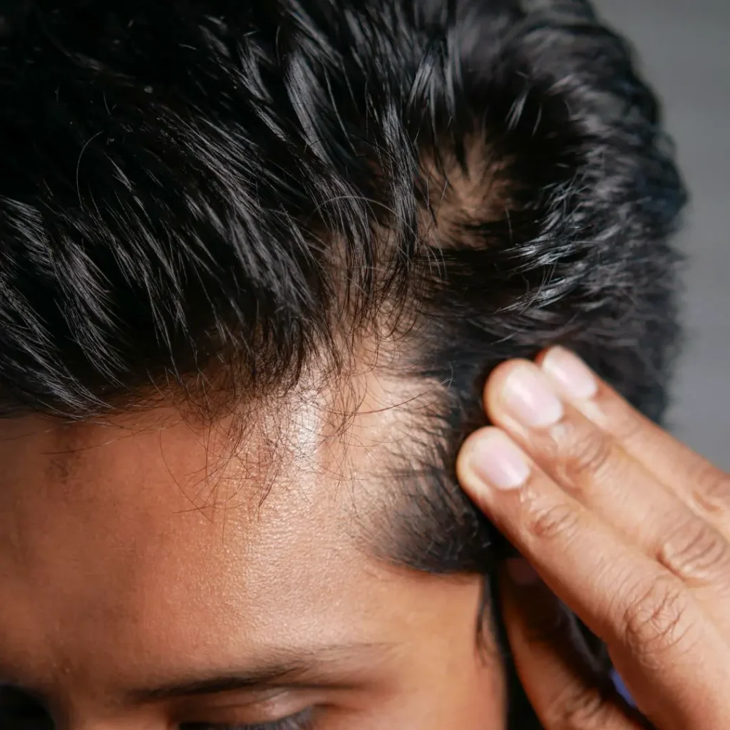 cgt-aesthetics-prp-hair-injections-evergreen-park-westmont-il-desktop Platelet-rich plasma hair restoration treatment in Evergreen Park and Westmont IL