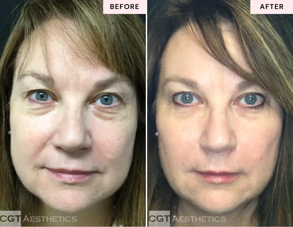 Cheek filler and smile line filler before and after at CGT Aesthetics in Evergreen Park and Westmont