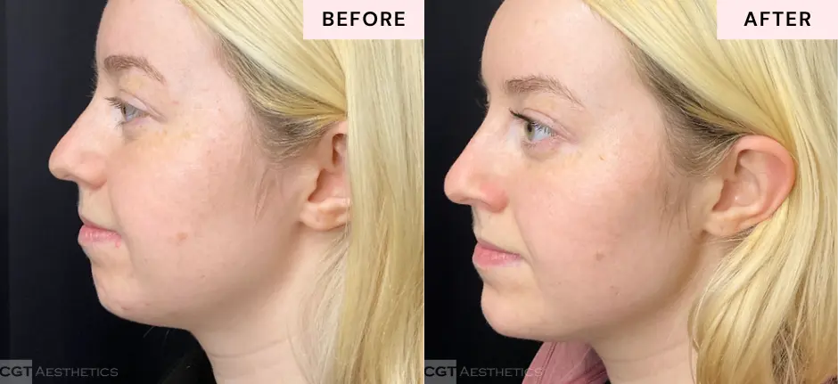 Chin, jawline, and cheek filler before and after at CGT Aesthetics in Evergreen Park and Westmont