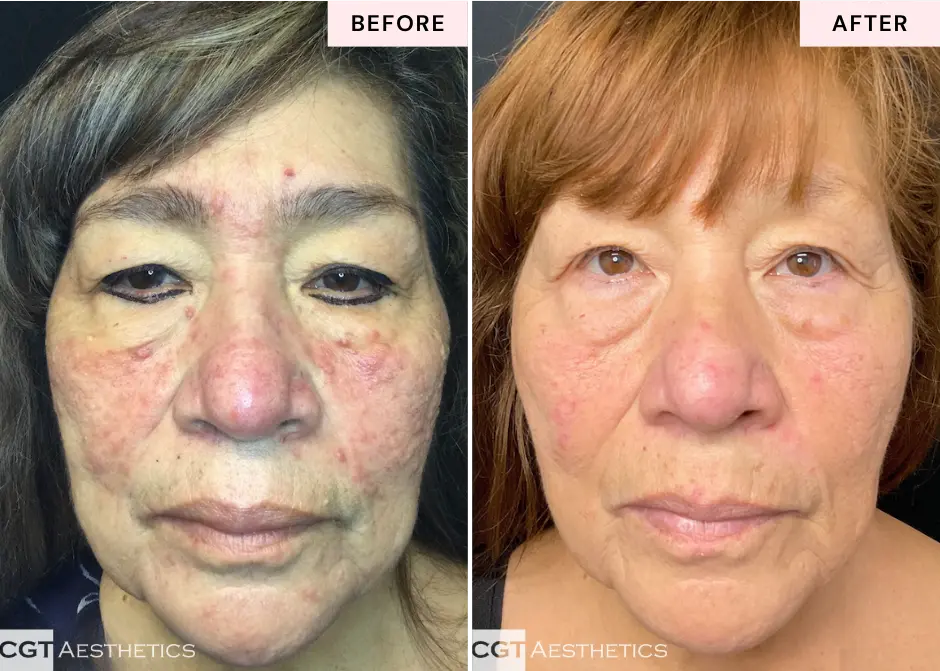 Chemical peel before and after for uneven tone at CGT Aesthetics in Evergreen Park and Westmont