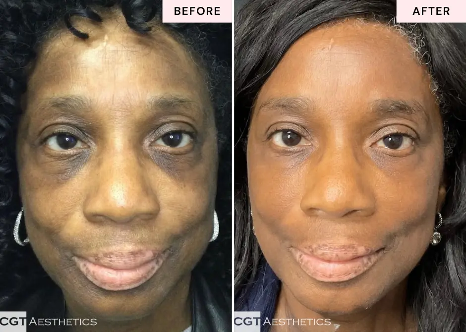 Chemical peel before and after for uneven tone at CGT Aesthetics in Evergreen Park and Westmont
