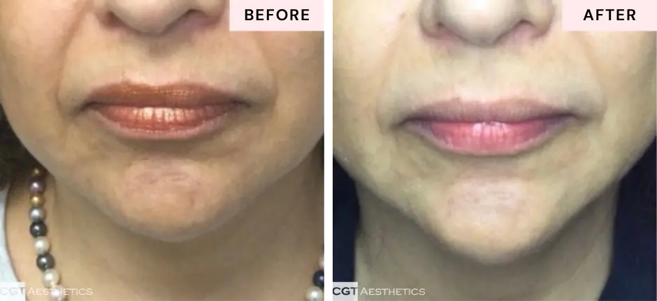 Chin filler before and after at CGT Aesthetics in Evergreen Park and Westmont