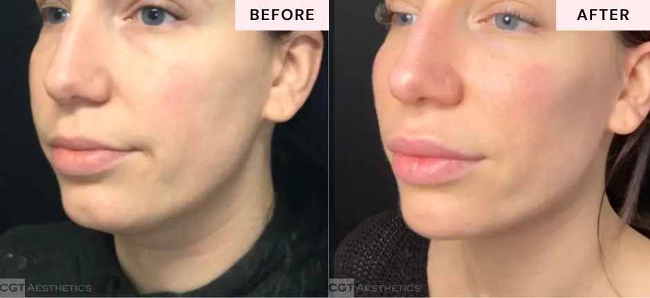 Cheek, jawline, and chin contouring with filler before and after at CGT Aesthetics in Evergreen Park and Westmont