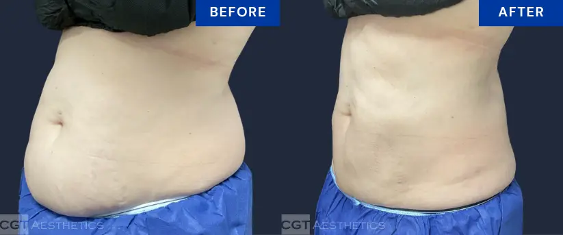 Before and after CoolSculpting Elite treatment for abdominal fat reduction at CGT Aesthetics
