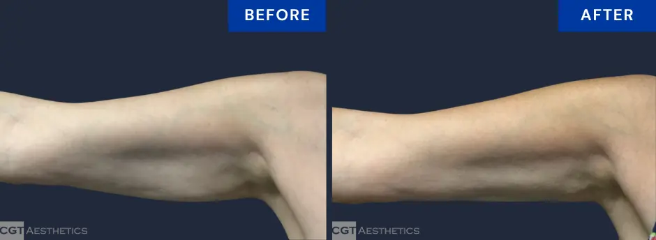 CoolSculpting arms before and after at CGT Aesthetics in Evergreen Park and Westmont