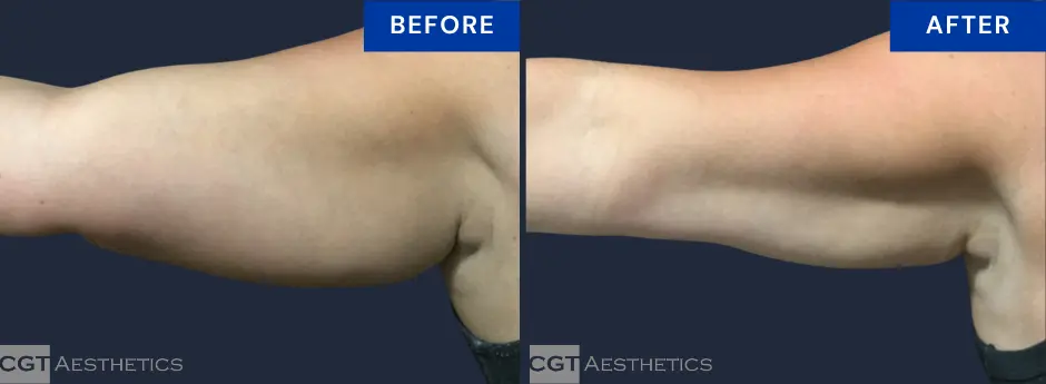 CoolSculpting arms before and after at CGT Aesthetics in Evergreen Park and Westmont