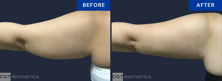 CoolSculpting arms before and after at CGT Aesthetics in Evergreen Park and Westmont