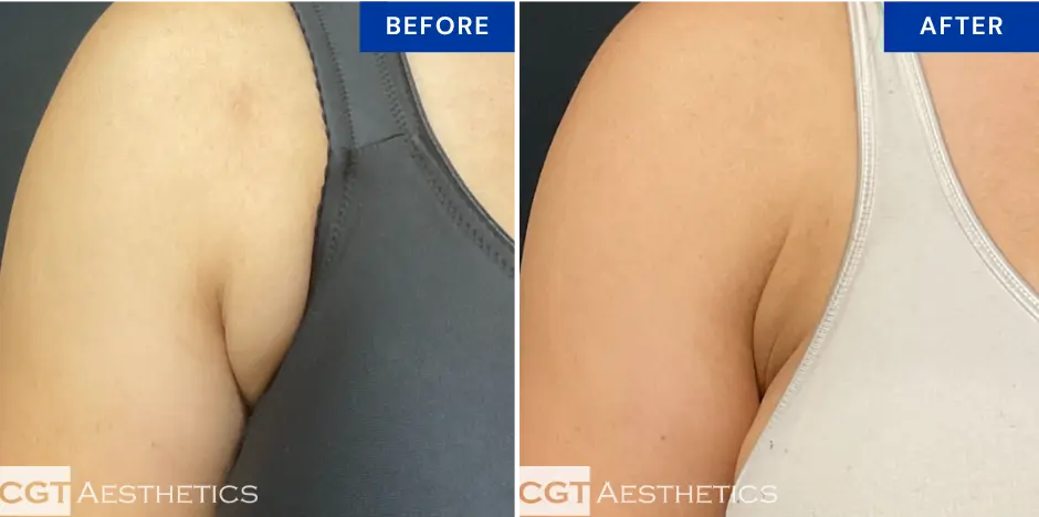 CoolSculpting bra puff before and after at CGT Aesthetics in Evergreen Park and Westmont