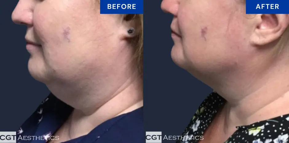 CoolSculpting chin before and after at CGT Aesthetics in Evergreen Park and Westmont
