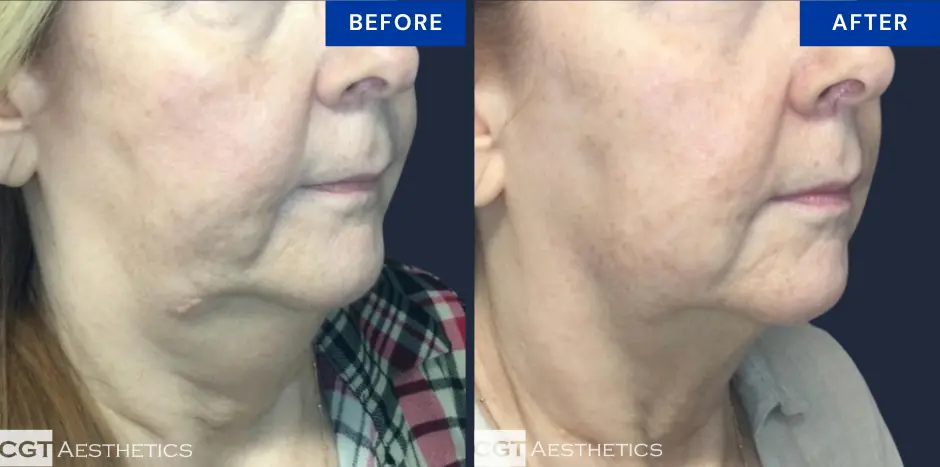CoolSculpting double chin before and after at CGT Aesthetics in Evergreen Park and Westmont