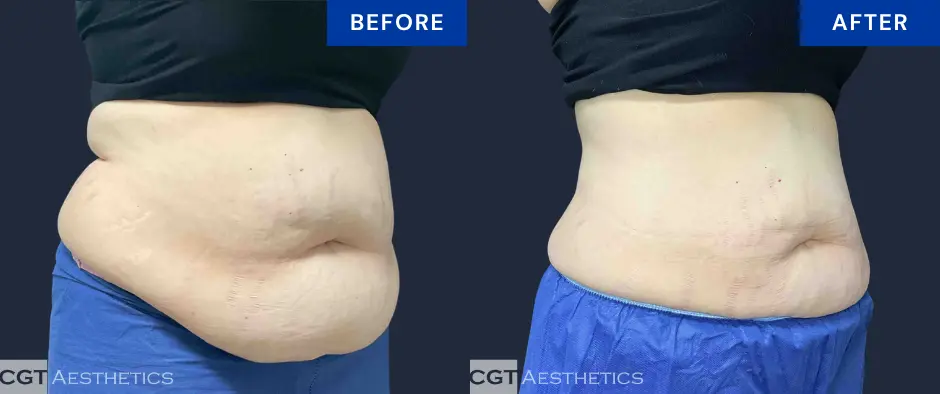 CoolSculpting Elite abdomen and flanks before and after results at CGT Aesthetics
