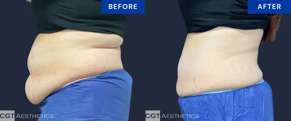 CoolSculpting Elite abdomen and flanks before and after results at CGT Aesthetics