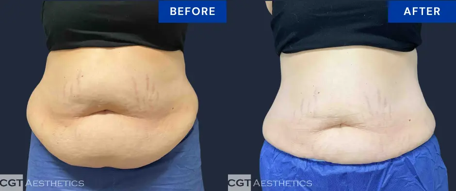 CoolSculpting Elite abdomen and flanks before and after results at CGT Aesthetics