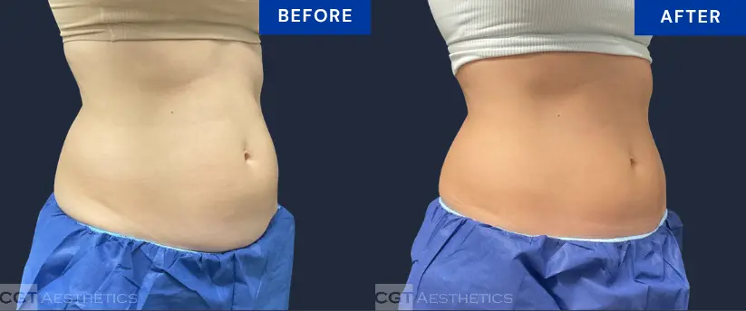 CoolSculpting Elite abdomen before and after results showing reduction of stubborn abdominal fat after treatment