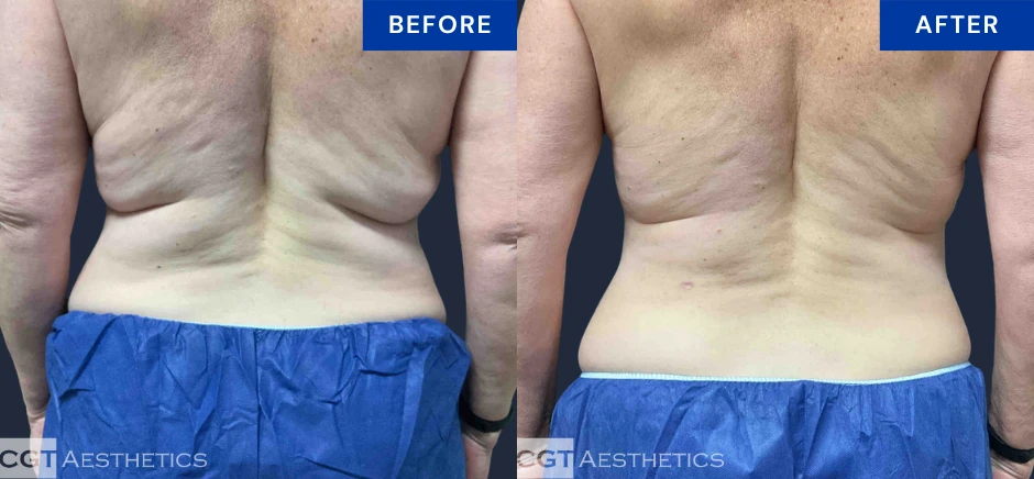 CoolSculpting Elite back and bra fat before and after result at CGT Aesthetics