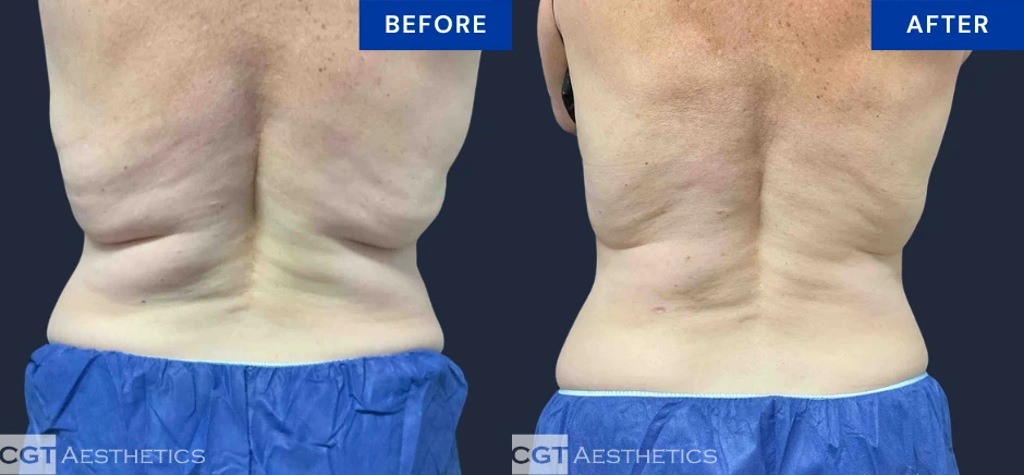 CoolSculpting Elite back and bra fat before and after result at CGT Aesthetics