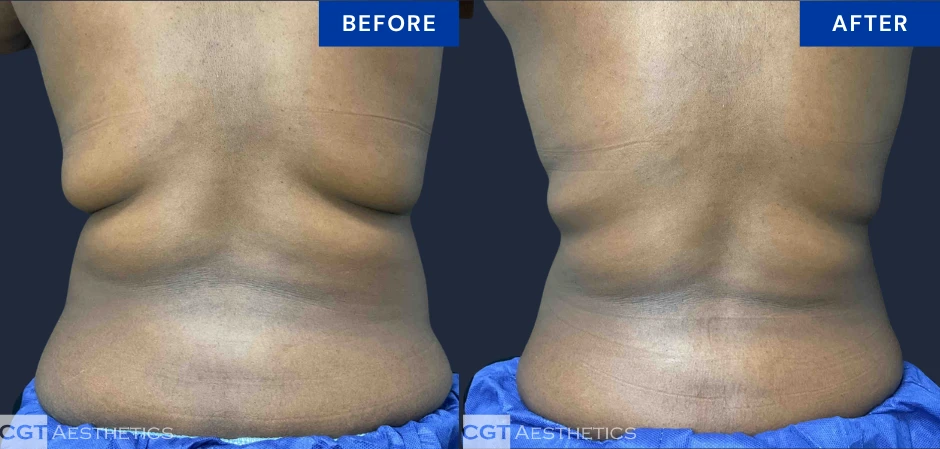 CoolSculpting Elite back and bra fat before and after result at CGT Aesthetics