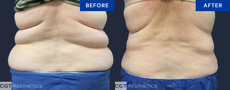 CoolSculpting Elite back fat before and after contouring result at CGT Aesthetics