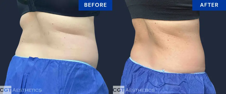 Before and after CoolSculpting Elite body contouring results for bra fat and flanks at CGT Aesthetics