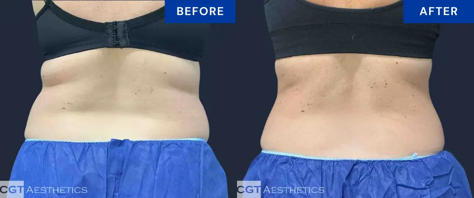 CoolSculpting Elite before and after results for flanks and bra fat at CGT Aesthetics