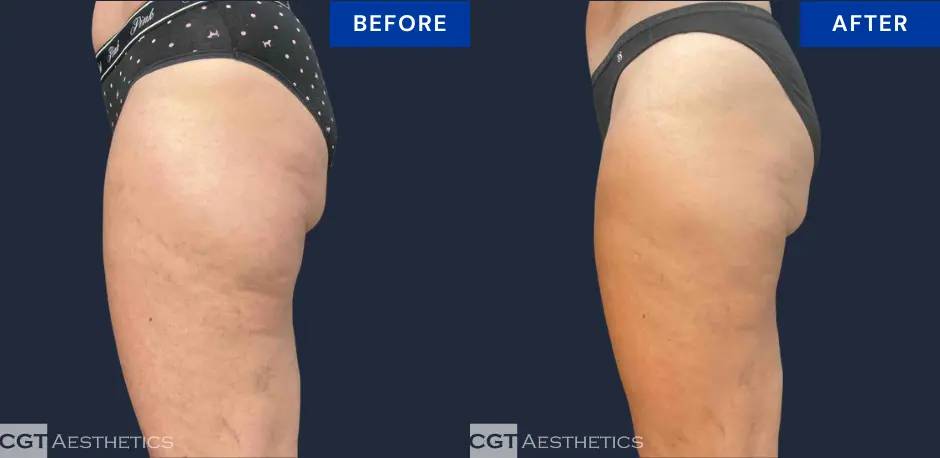 CoolSculpting Elite inner and outer thigh before and after result at CGT Aesthetics, side view