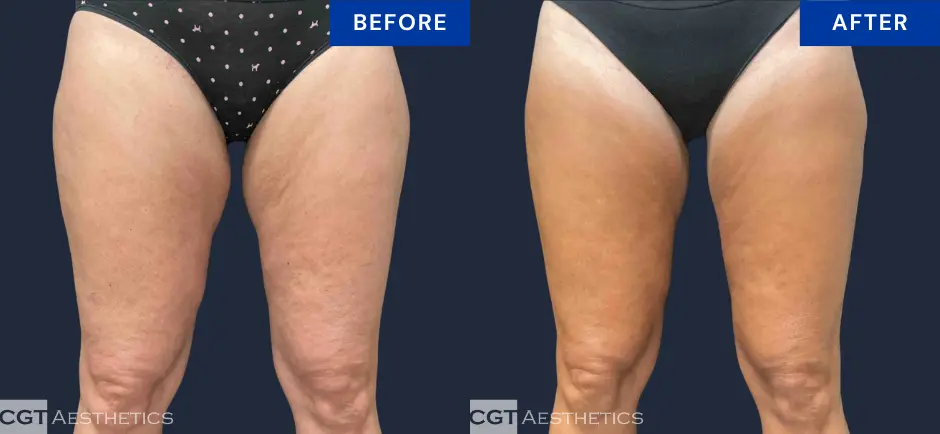 CoolSculpting Elite inner and outer thigh before and after body contouring result at CGT Aesthetics, front view