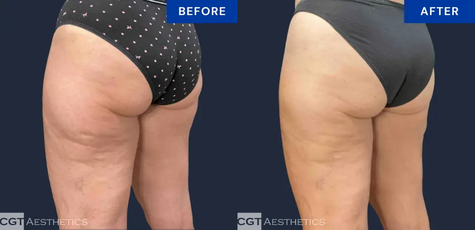 CoolSculpting Elite inner and outer thigh before and after contouring result at CGT Aesthetics, angled view