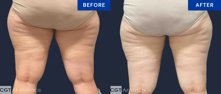 CoolSculpting Elite inner and outer thigh before and after body contouring result at CGT Aesthetics