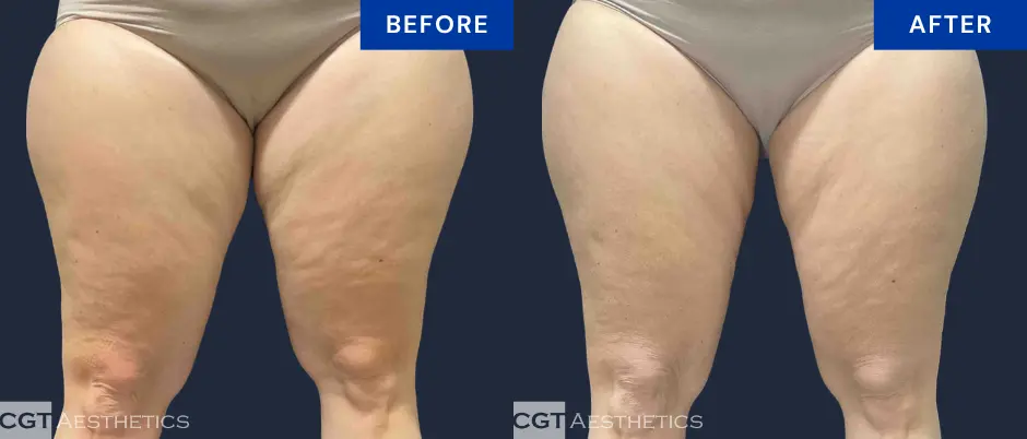 CoolSculpting Elite inner and outer thigh before and after body contouring result at CGT Aesthetics