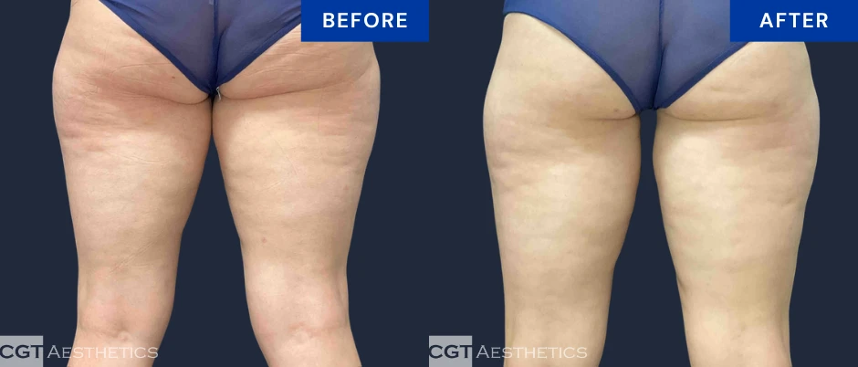 CoolSculpting Elite inner thigh and banana roll before and after result at CGT Aesthetics