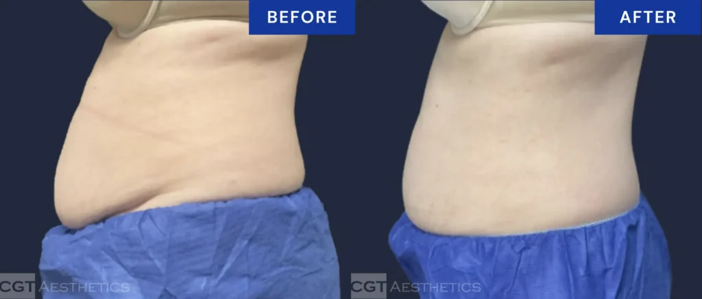CoolSculpting Elite before and after results for abdomen and flanks (love handles) showing reduction of stubborn fat after treatment