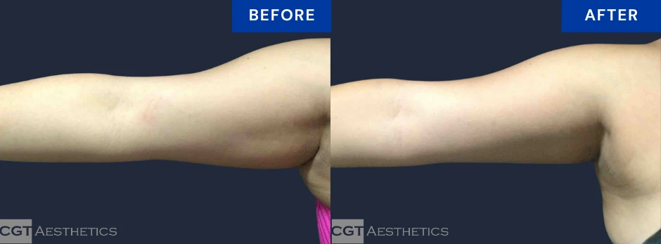 CoolSculpting Elite before and after result for stubborn upper arm fat at CGT Aesthetics