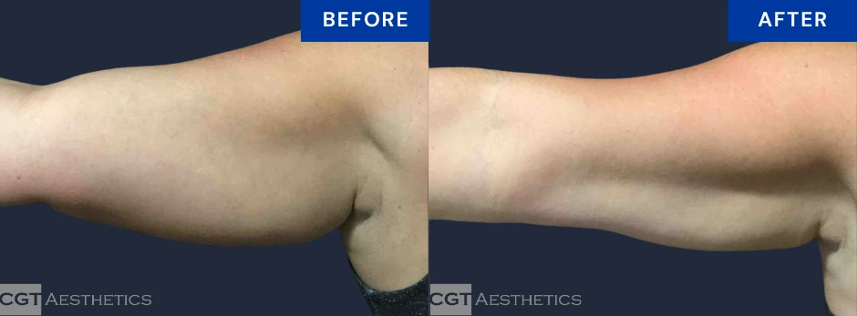 CoolSculpting Elite before and after result for stubborn upper arm fat at CGT Aesthetics