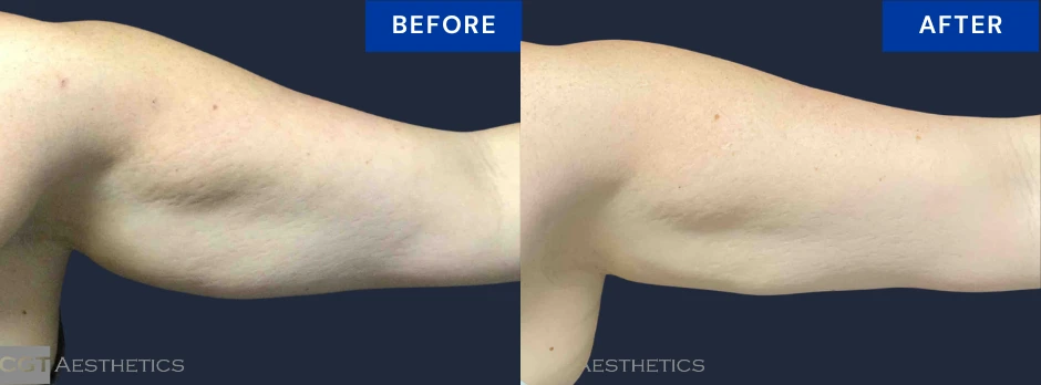 CoolSculpting Elite before and after result for stubborn upper arm fat at CGT Aesthetics