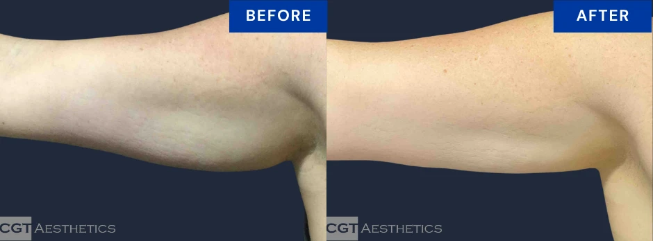 CoolSculpting Elite before and after result for stubborn upper arm fat at CGT Aesthetics