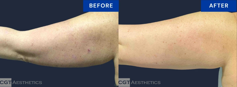 CoolSculpting Elite before and after result for stubborn upper arm fat at CGT Aesthetics
